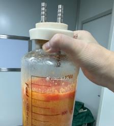 文山水动力吸脂手术要做多久？